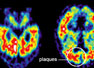 Hoy es el Día Internacional del Alzheimer